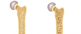 Recognizing The Early Warning Signs Of Osteoporosis
